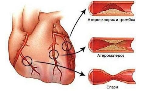 Заболевания коронарных артерий (ИБС)