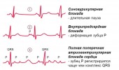 Как осуществляется диагностика блокады сердца на ЭКГ