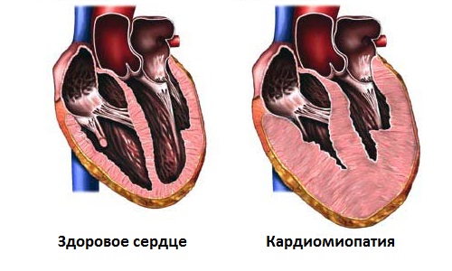 Кардиомиопатия в сравнении со здоровым сердцем