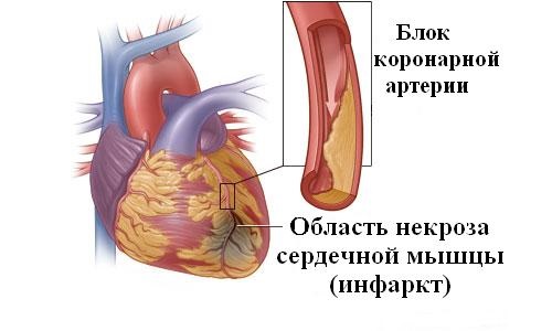 Схема инфаркта миокарда