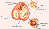 Диагностика желудочковой экстрасистолии при ЭКГ