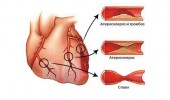 Признаки и симптомы невроза сердца