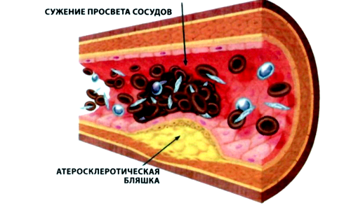 Схема атеросклероза