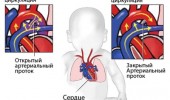 Какие болезни сердца относятся к МАРС?
