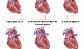 Физиологический и патологический синусовый ритм сердца