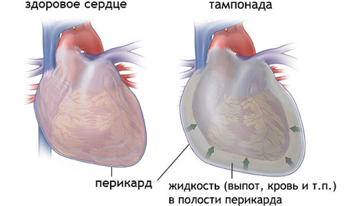 Схема тампонады сердца